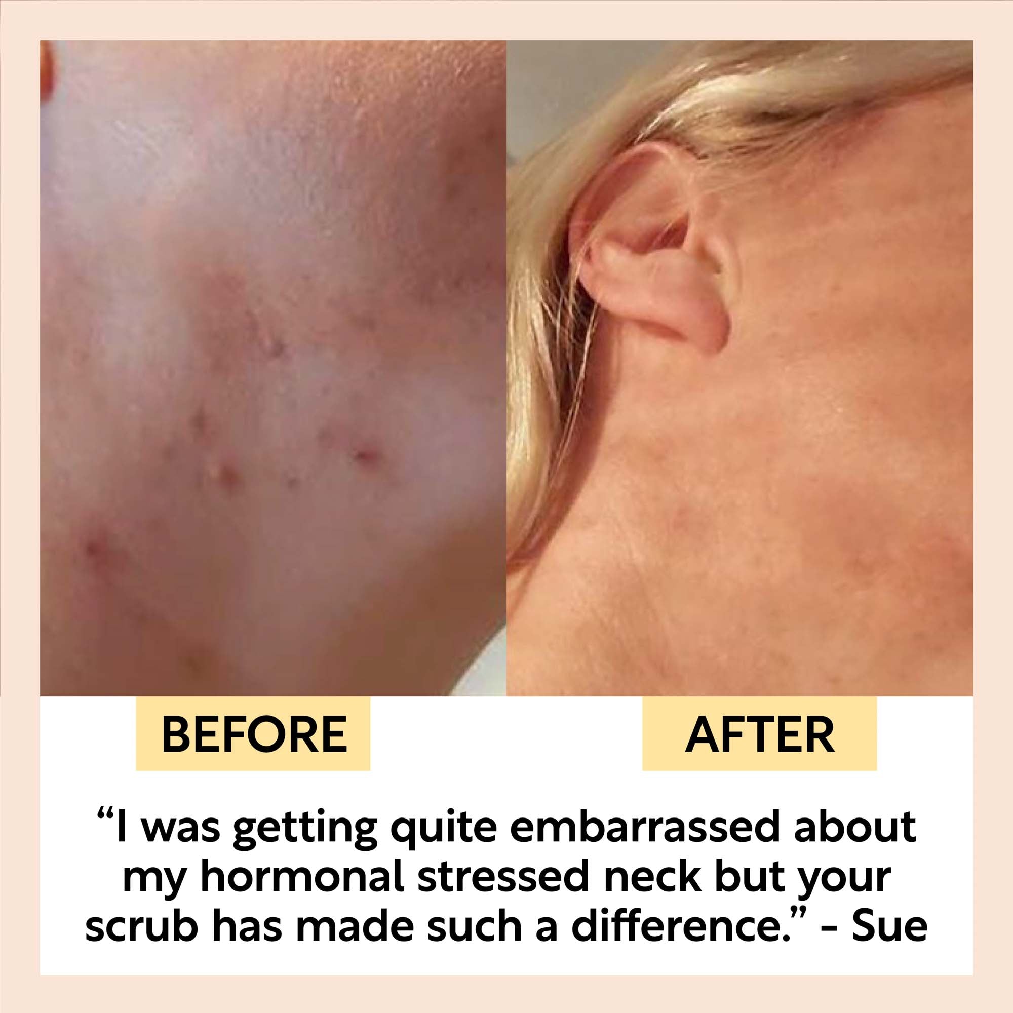 The Acne-Prone Bundle