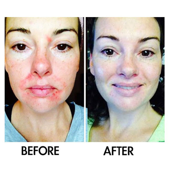 Derm #1 Adult Acne Two-Step Regimen plus FREE Blemish Corrector