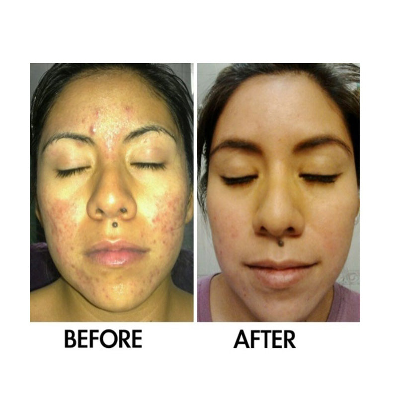 Derm #1 Adult Acne Two-Step Regimen plus FREE Blemish Corrector