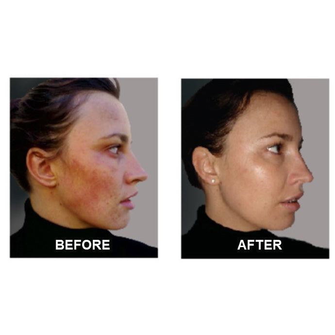 Derm #1 Adult Acne Two-Step Regimen plus FREE Blemish Corrector
