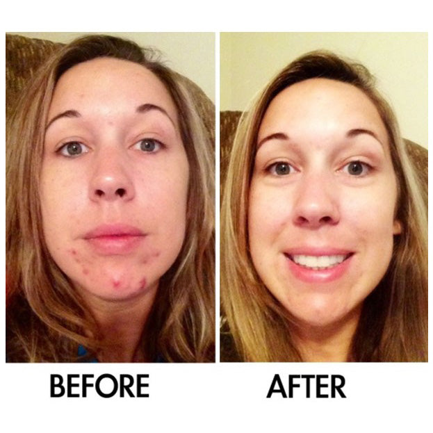 Derm #1 Adult Acne Two-Step Regimen plus FREE Blemish Corrector